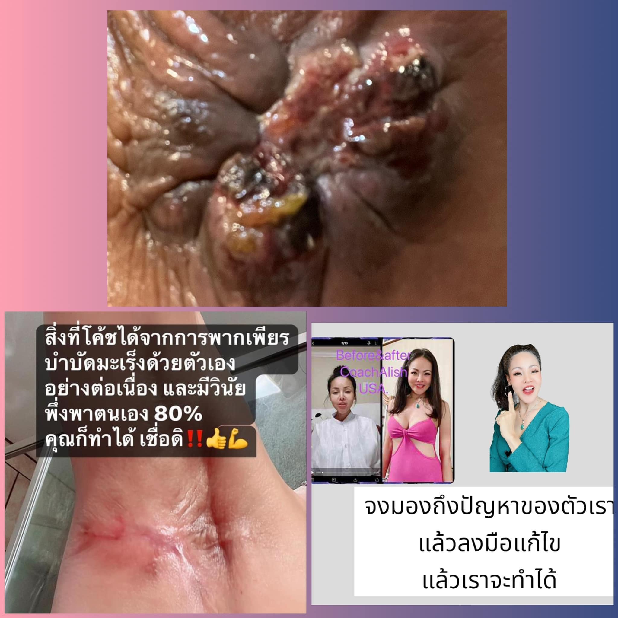 คอร์สเรียนพิเศษจากโค้ชอลิส สรุป 100 เทคนิคพิชิตมะเร็ง