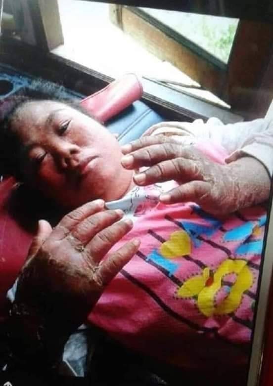 รีวิวพอลลิติน (Pollitin) โรคสะเก็ดเงิน