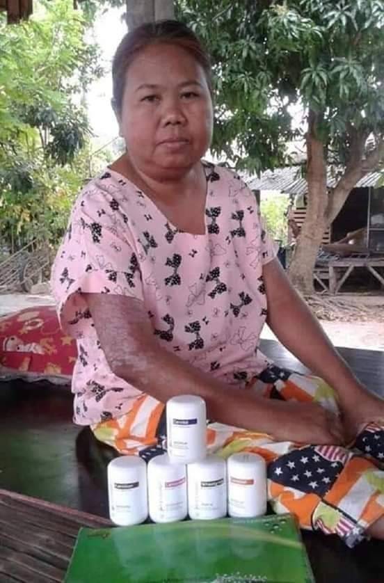 รีวิวพอลลิติน (Pollitin) โรคสะเก็ดเงิน