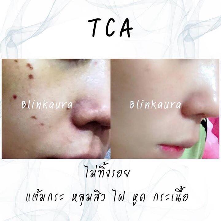 TCA 100%แต้มหลุมสิวลึก กระ ไฝ ฝ้าแต้มกระนูน ใช้จี้ขี้แมงวัน หรือไฝ เม็ดใหญ่ ๆ ช่วยให้สิวแห้งเร็วTrichloroacetic Acid Solution TCA 100% Concentrated Chemical Skin Peel ขนาด 3ml