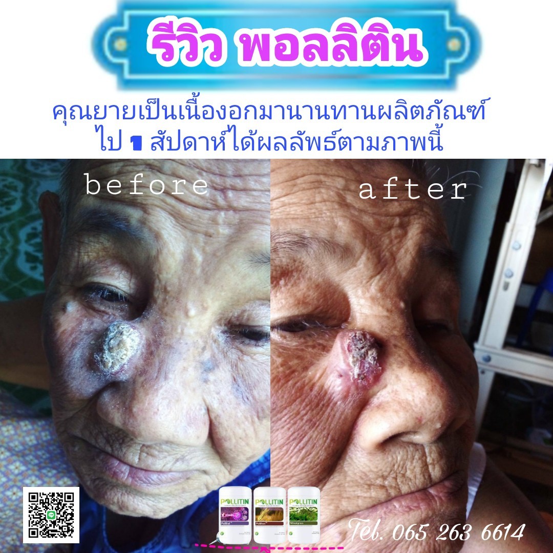 รีวิวพอลลิติน pollitin