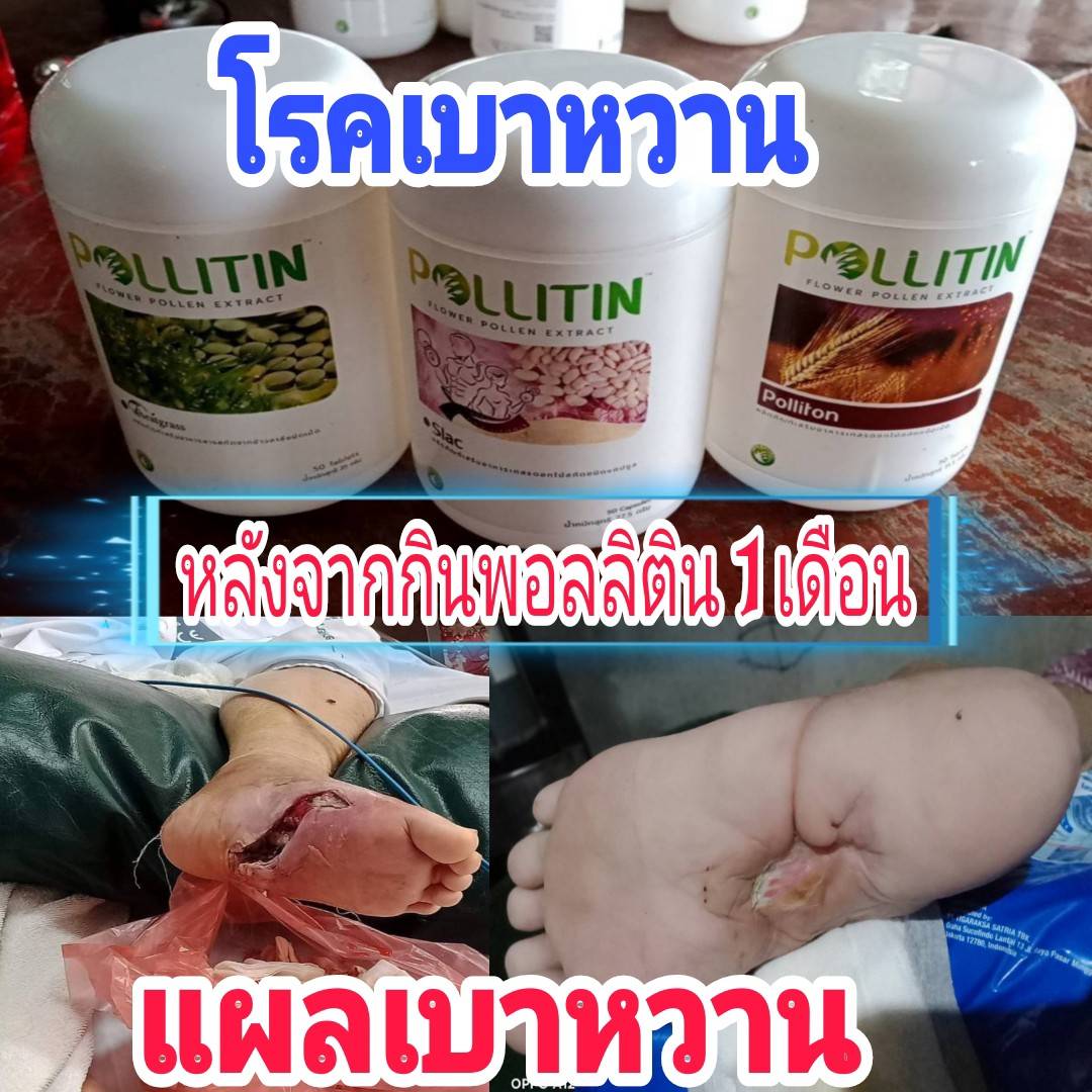 โรคเบาหวาน (พอลลิติน)