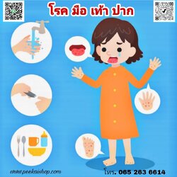 โรคมือ เท้า ปาก