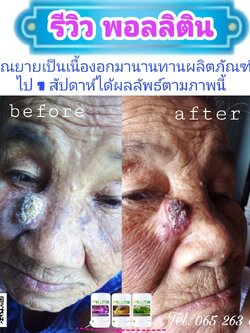 รีวิวพอลลิติน pollitin