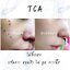 TCA 100%แต้มหลุมสิวลึก กระ ไฝ ฝ้าแต้มกระนูน ใช้จี้ขี้แมงวัน หรือไฝ เม็ดใหญ่ ๆ ช่วยให้สิวแห้งเร็วTrichloroacetic Acid Solution TCA 100% Concentrated Chemical Skin Peel ขนาด 3ml